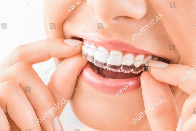 Invisalign